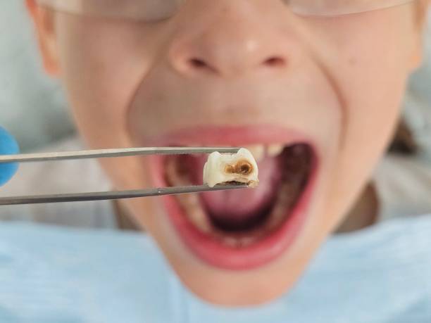 Best Emergency Tooth Extraction in Century, FL